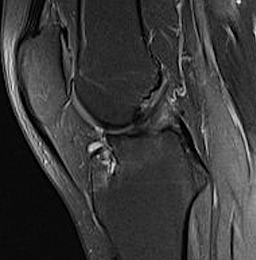 ACL MRI avulsion