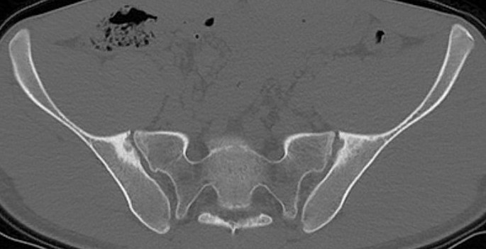 AS sacroilitis 3