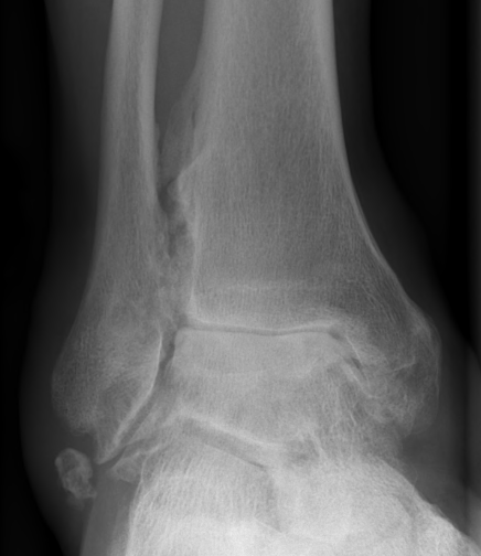 Ankle OA