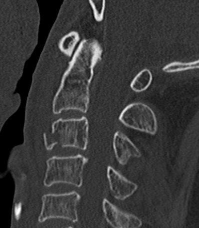 Tear drop fracture