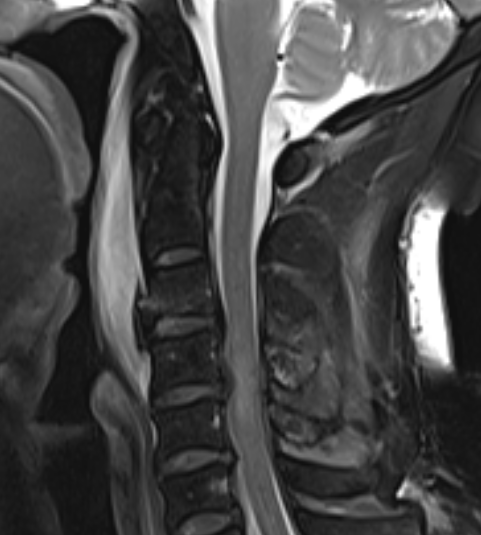 MRI teardrop fracture