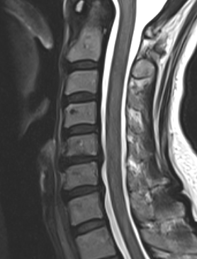 Cx spondylosis 2