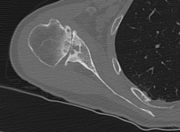 Scapula CT for total shoulder