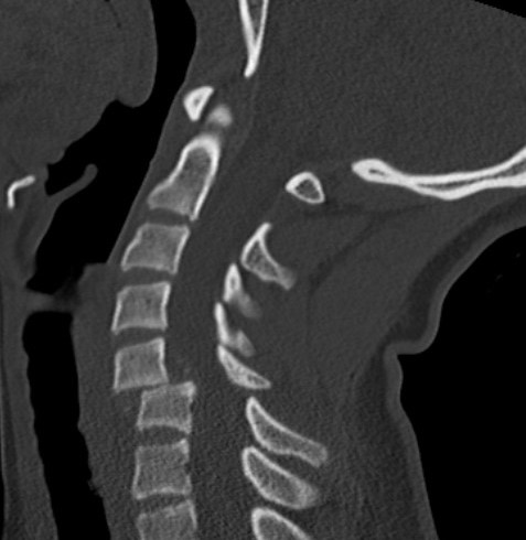 Bilateral facet CT