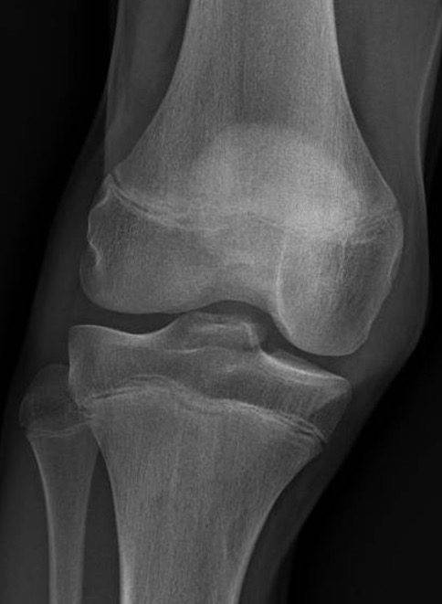 Bony ACL 1