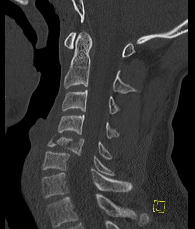 Cx burst sag CT