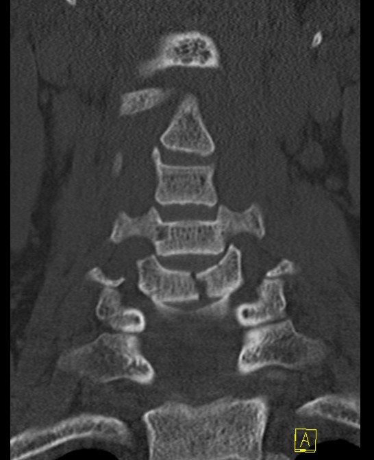 Cx burst coronal CT