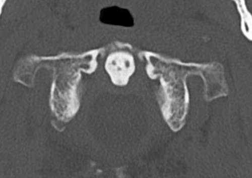 C1 lateral mass fracture