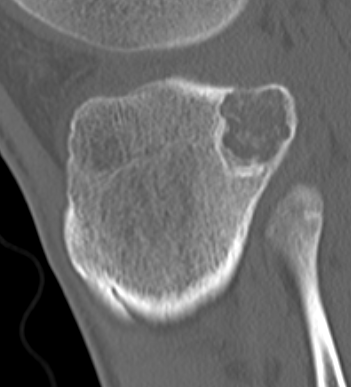 CT chondroblastoma 2