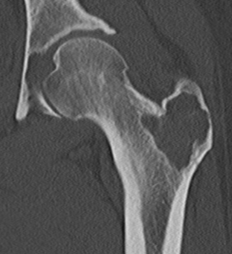 Chondroblastoma CT hip