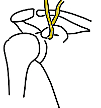 CCL anatomic reconstruction