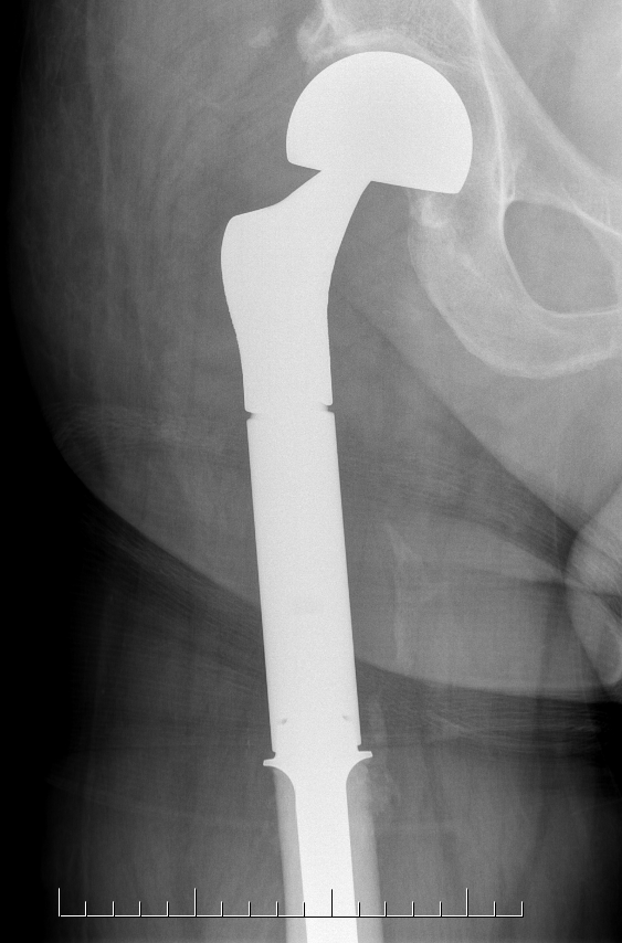 CS hip megaprosthesis