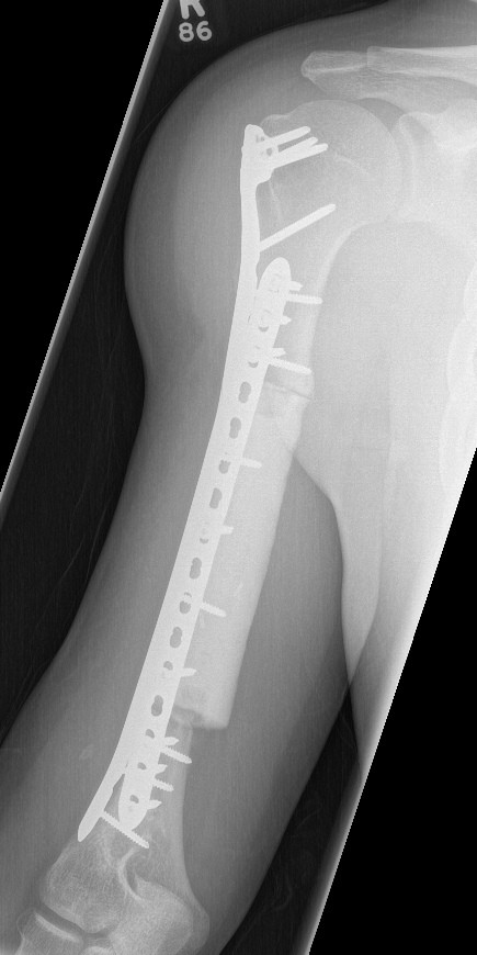 CS Humerus surgery 1