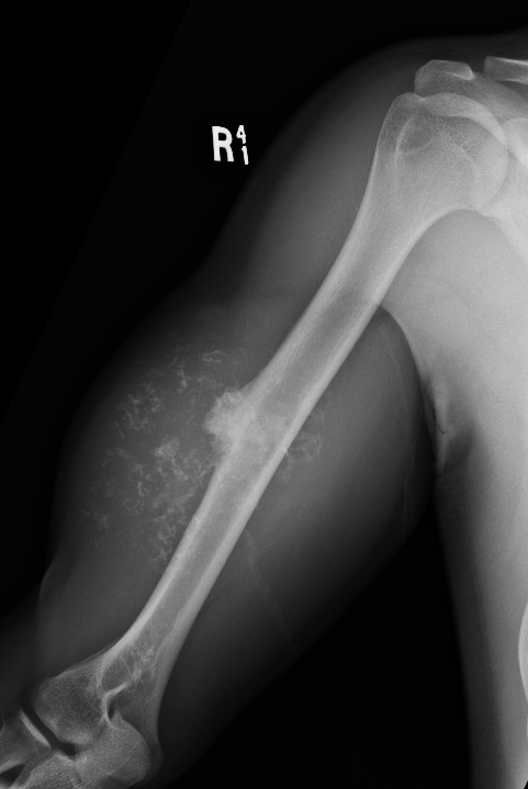 CS humerus 1