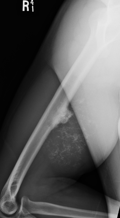 CS humerus 2