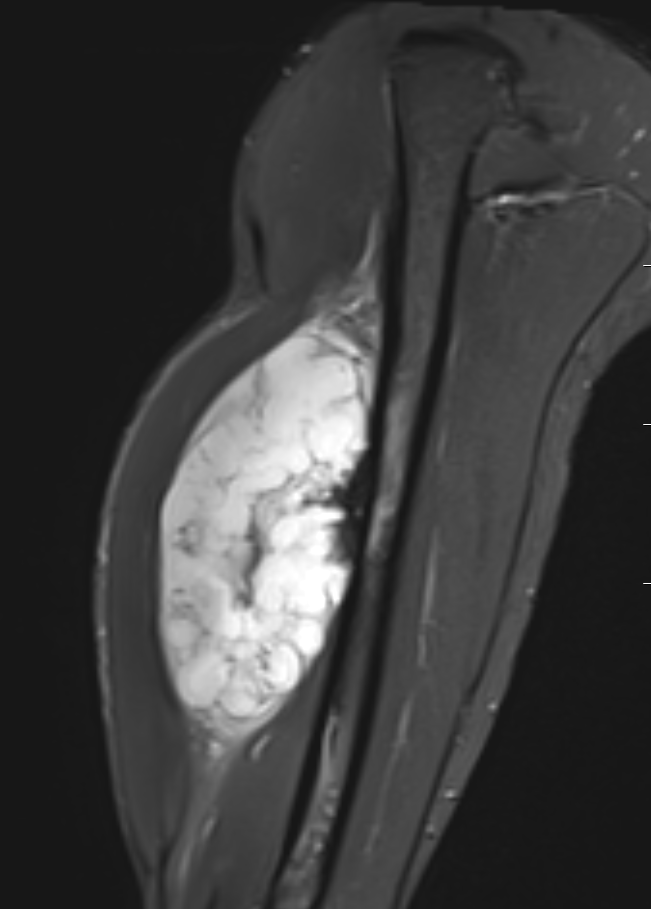 CS humerus MRI 1