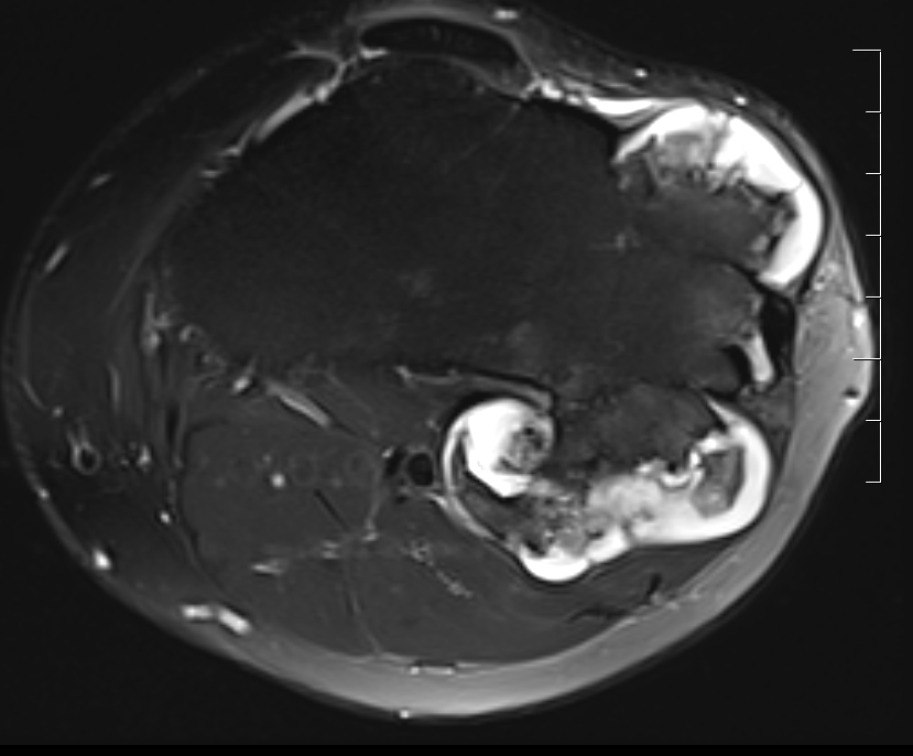 CS knee MRI 2