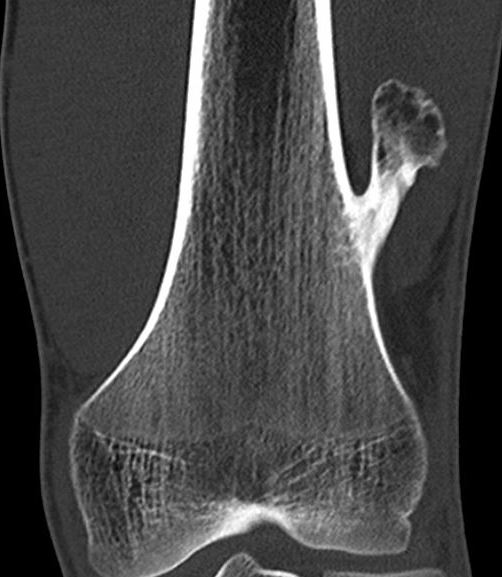 Osteochondroma CT