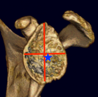 Standard glenoid instrumentation