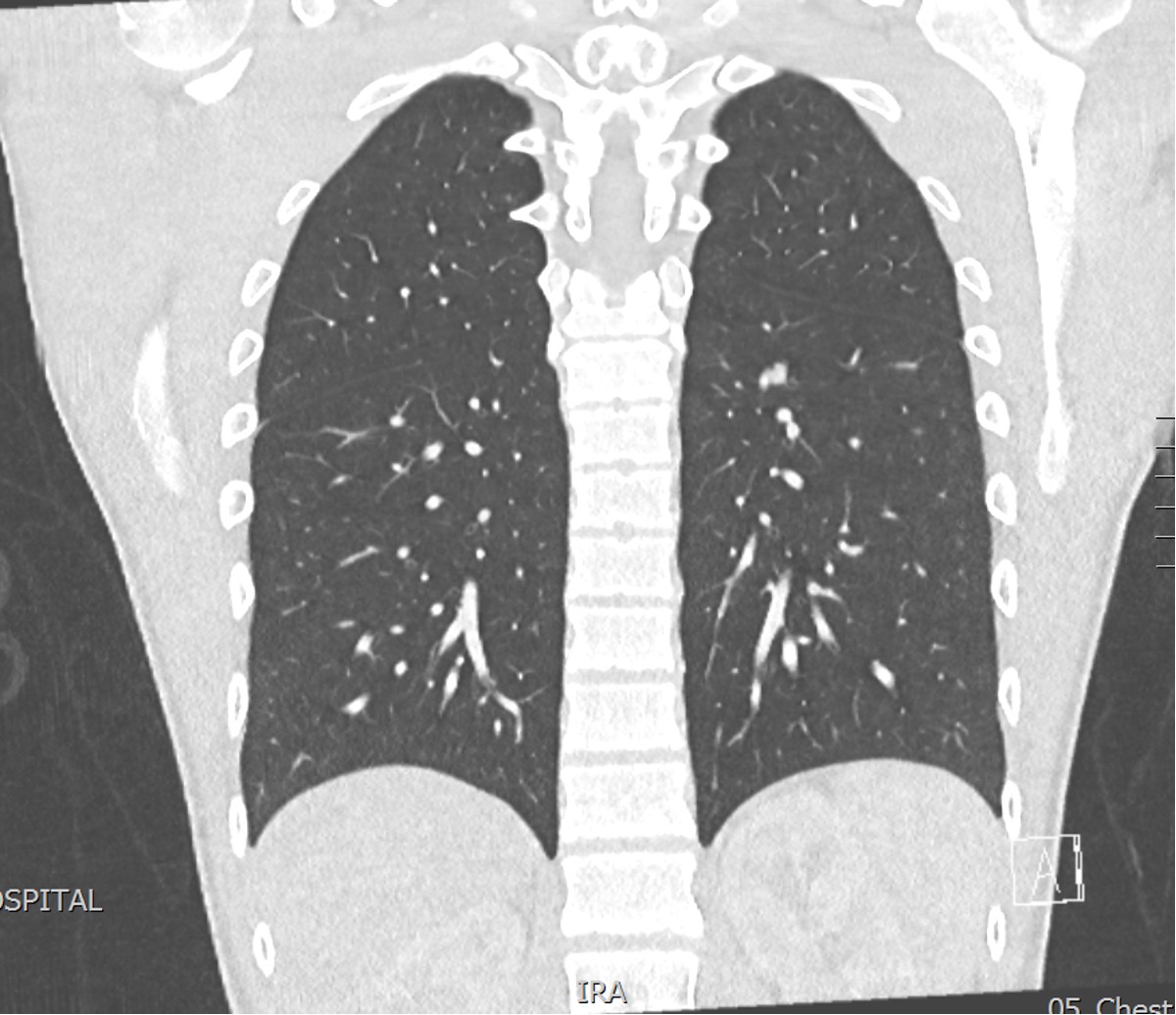 CT chest mets