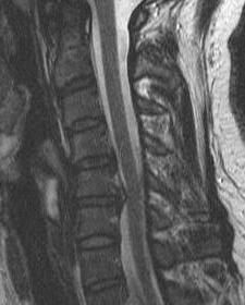 Two level myelopathy