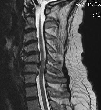 Cx stenosis 2