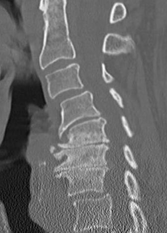 Spondylosis CT