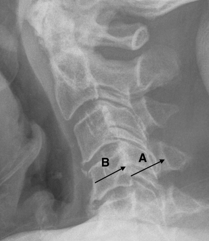 Pavlovs Ratio xray