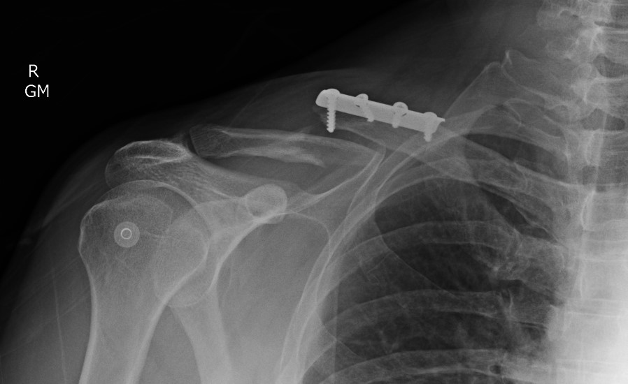 Clavicle peripros #