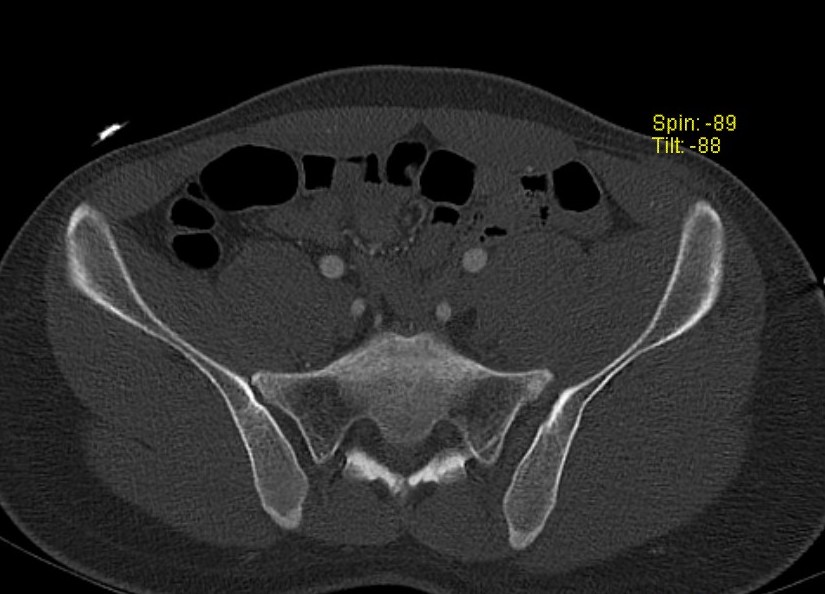 Complete SI joint disruption