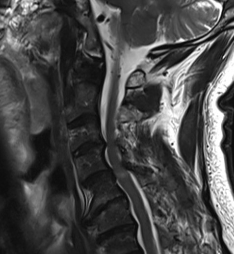 MRI central cord syndrome 2