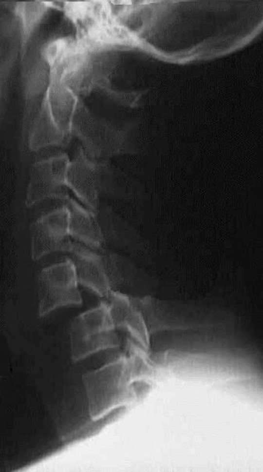 BIlateral facet joint dislocation