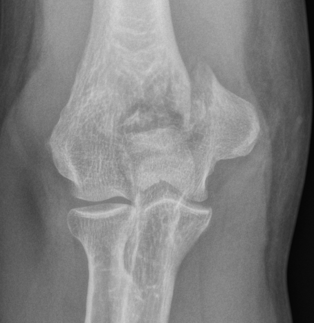 Distal humerus medial condyle