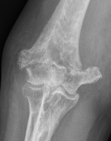 Elderly distal humerus 1