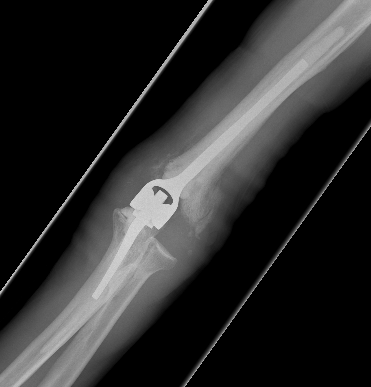 Distal humerus # TER 1