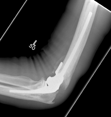 Distal humerus # replacement 2