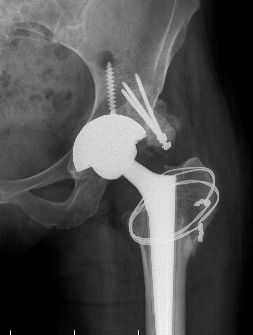 Bulk femoral head