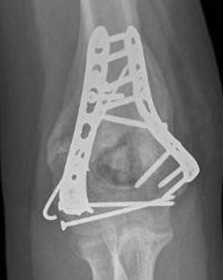 Distal humerus HO 1