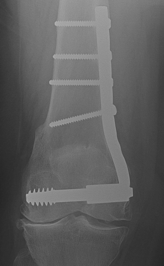 DFCO medial closing wedge