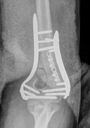 Elbow Parallel plates 1