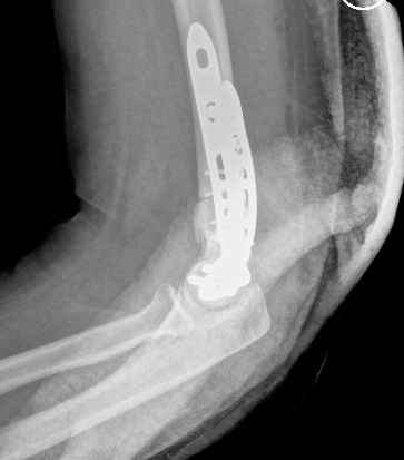 Elbow parallel plates 2