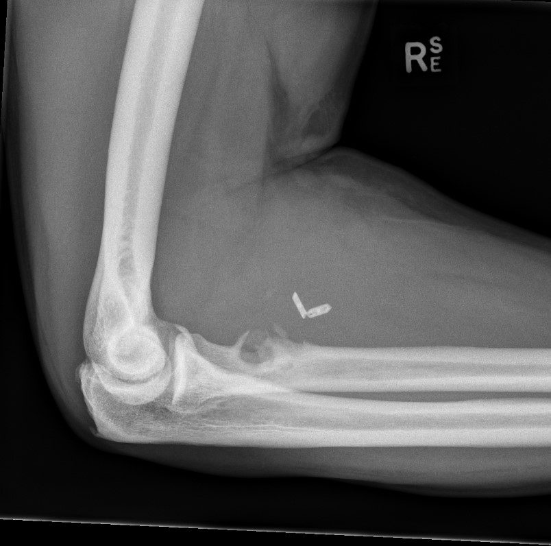 Distal biceps fixation failure