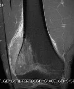 Ewings MRI femur 1