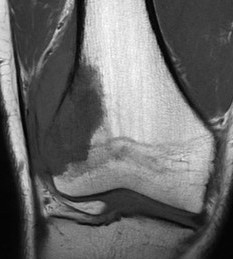 Ewings MRI femur 2