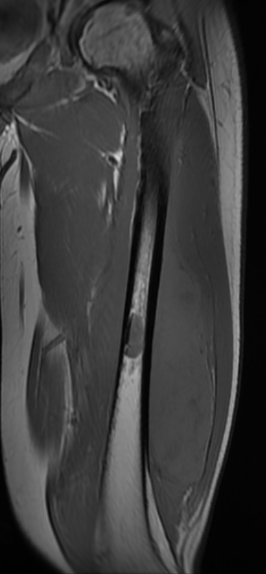 Ewings femur diaphysis MRI