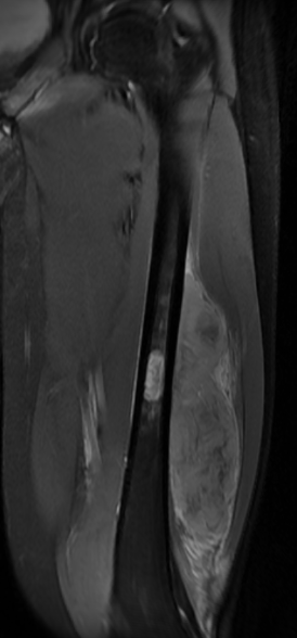 Ewings femoral diaphysis MRI 2