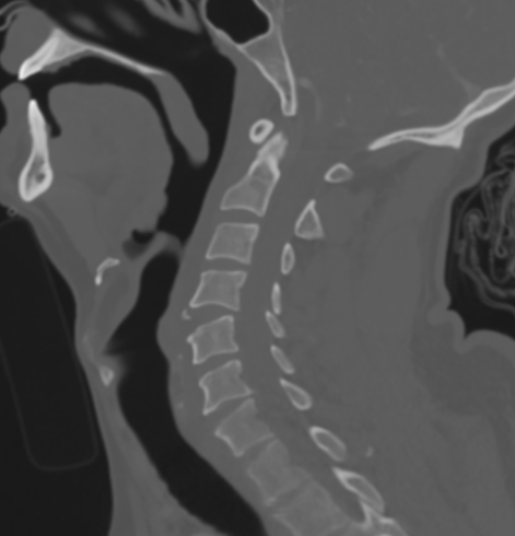 Extension Distraction CT