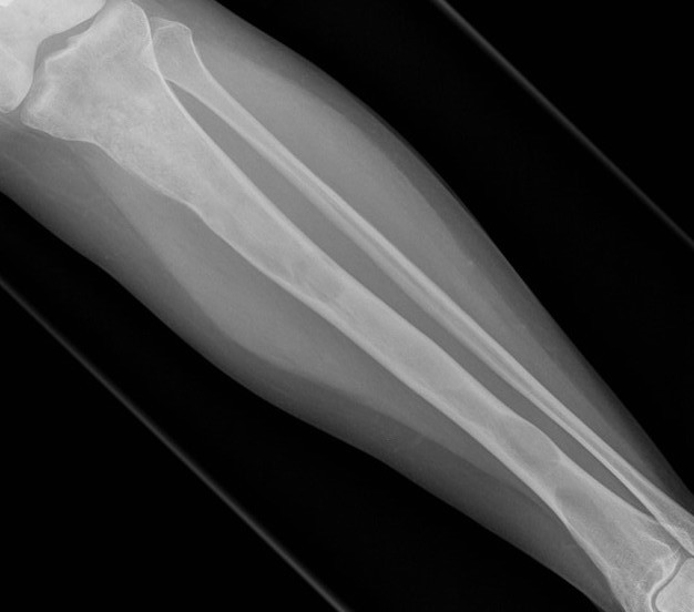 FD tibia 1