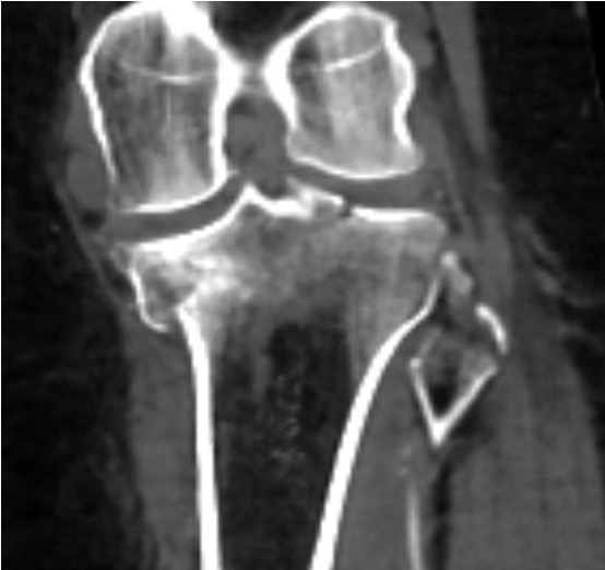 CT fibular head