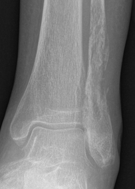 Osteosarcoma fibula